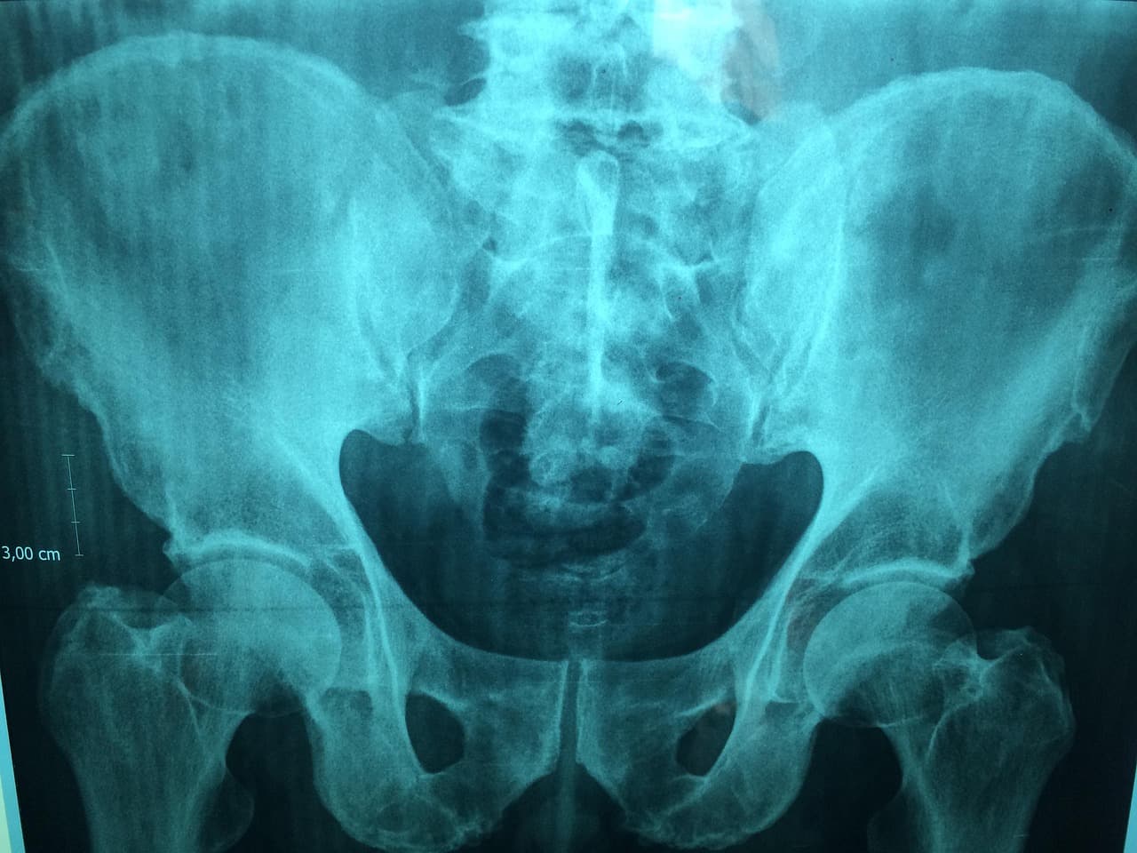 To Pack or to Embolise: The Pelvic Haemorrhage Dilemma