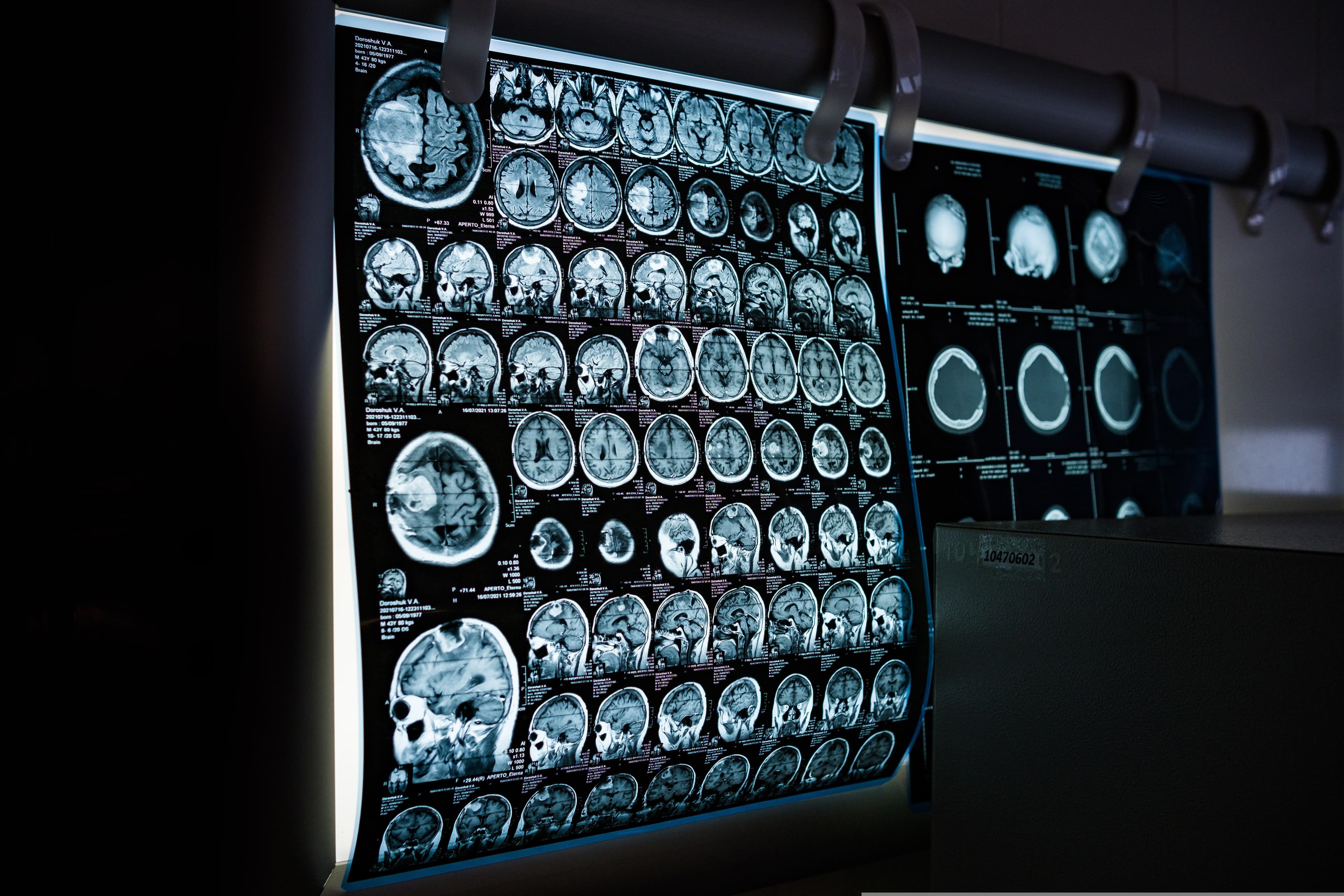The Injury That Announces Itself Too Late: Should Every Blunt Trauma Patient Have a Neck CTA?